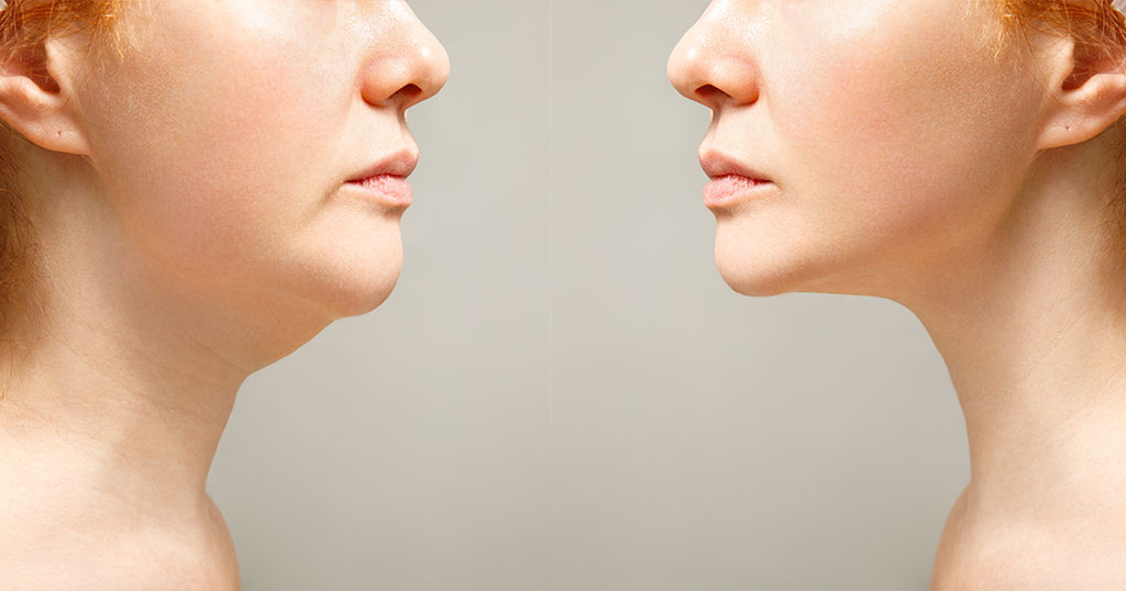 Lipoplastia de Papada e Cervicoplastia