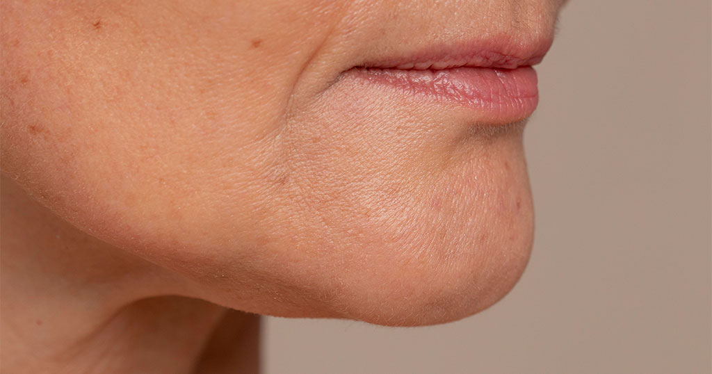 Lipoplastia de Papada e Cervicoplastia